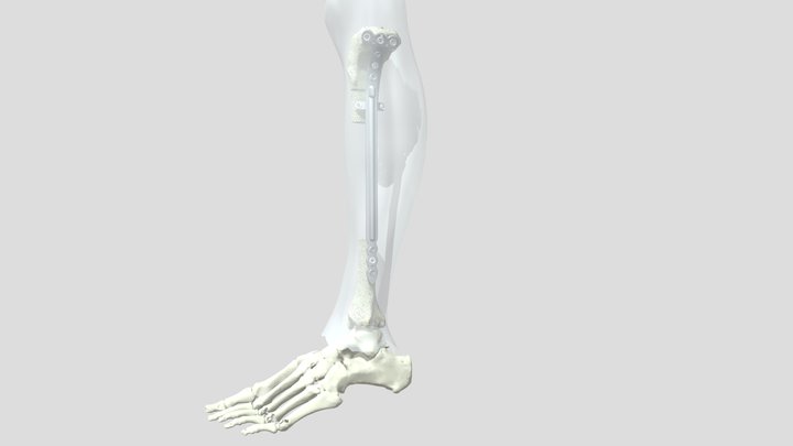 IMPLANTE 3D Model