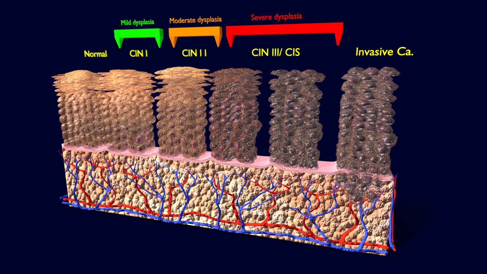 CIN Cervical cancer intraepithelial neoplasia - Buy Royalty Free 3D ...