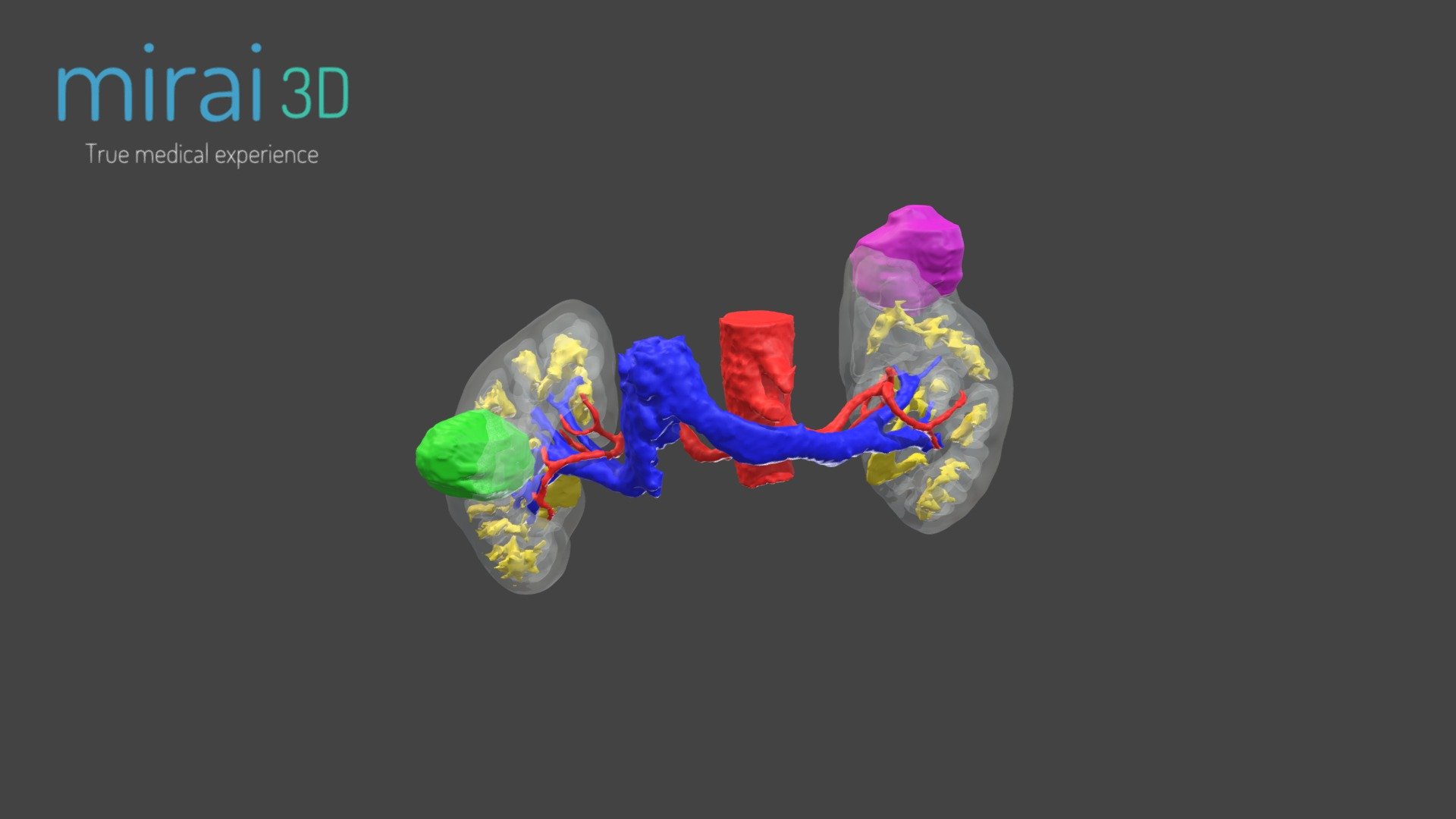 3D Model for Laparoscopic Partial Nephrectomy