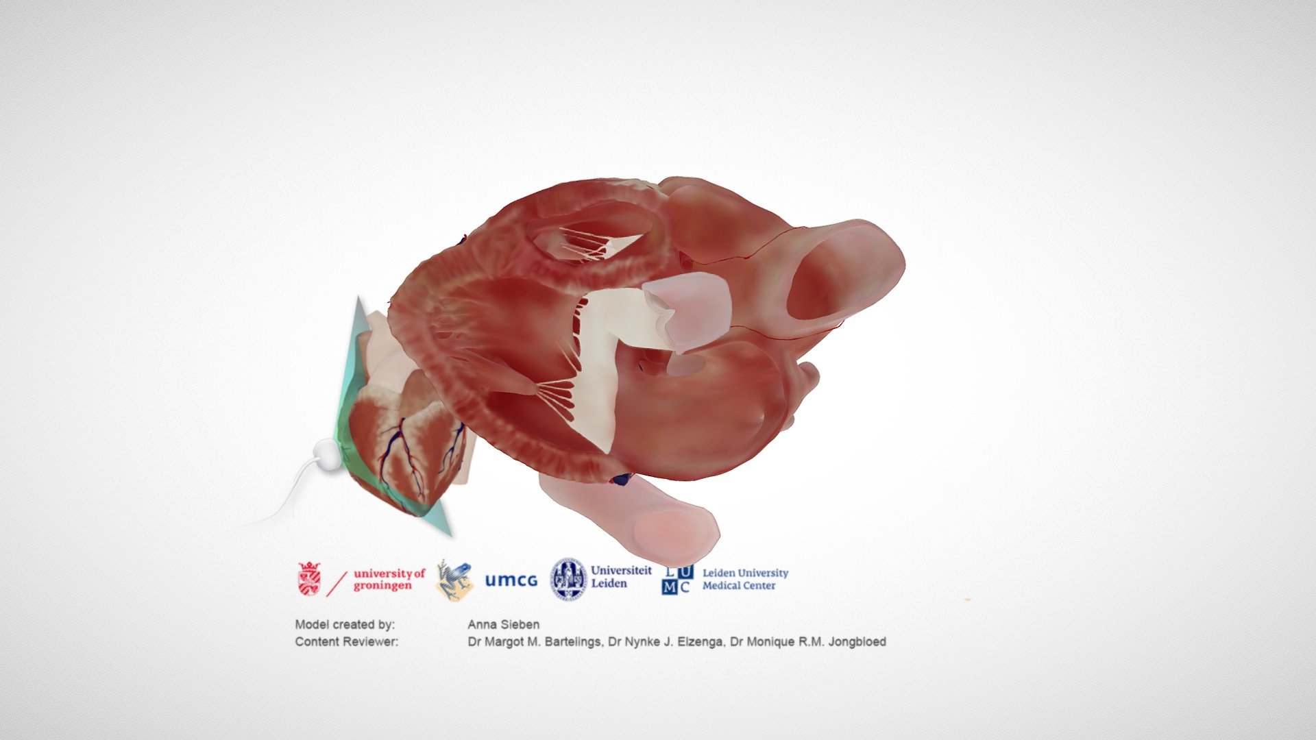 Atrioventricular septal defect, PSLAX