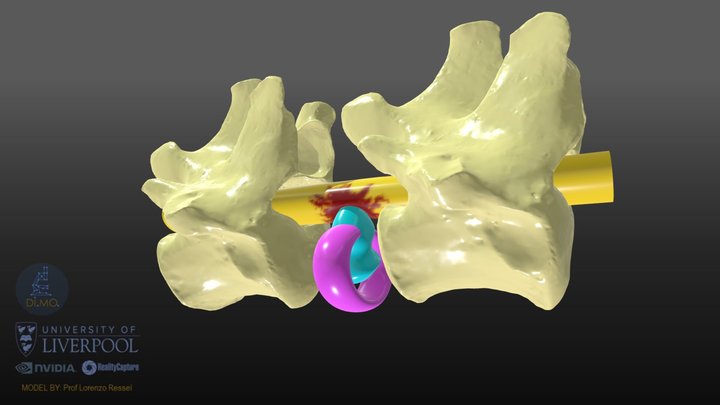 MODEL_Disc_Herniation_Spinal_Cord 3D Model