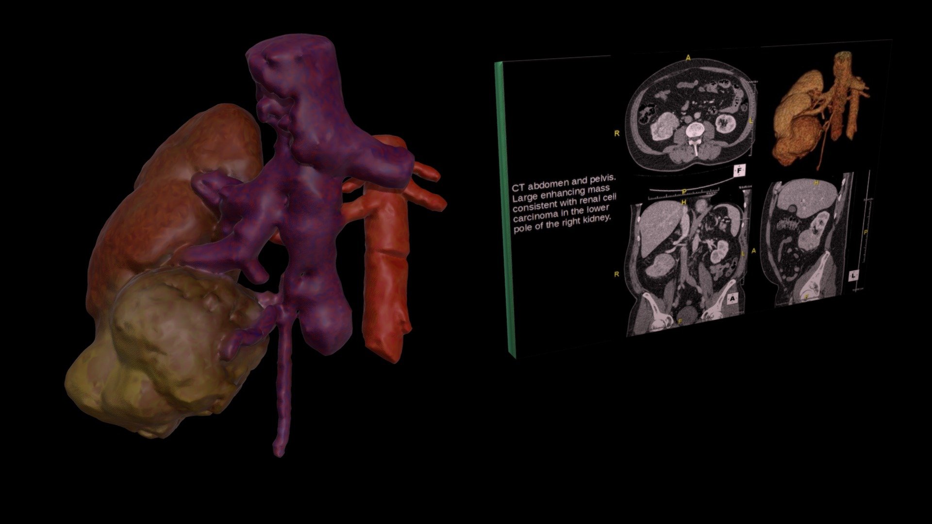 Renal Cell Carcinoma - 3D model by tl0615 [ed893ec] - Sketchfab