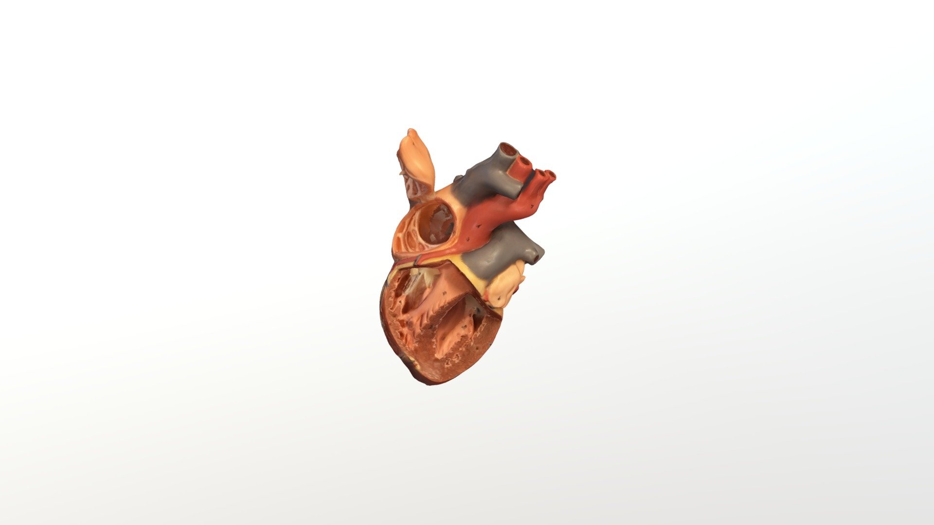 Post- Dissection Heart