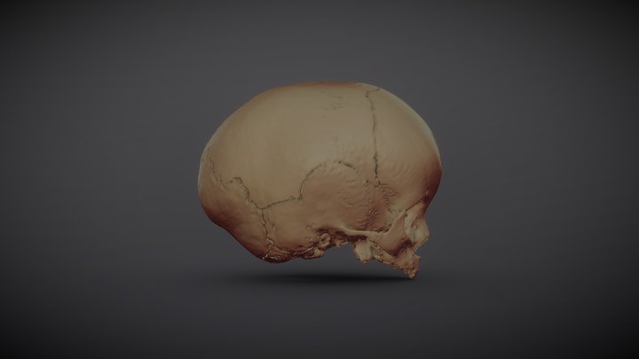 Child Craniosynostosis 3D Model