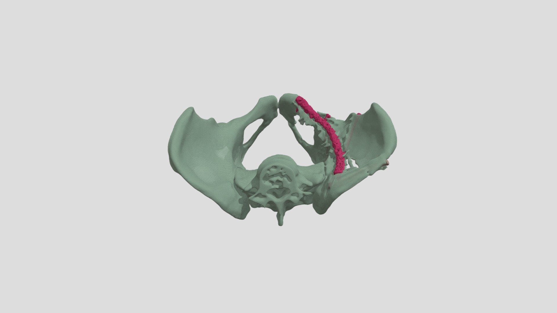 Pelvis And Hardware
