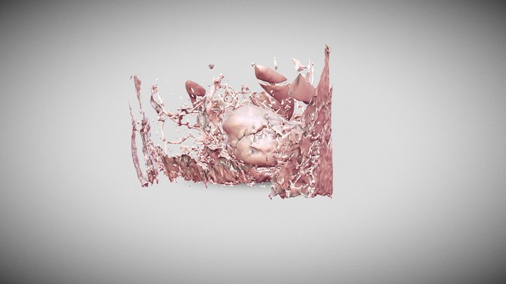 Tumor SKULL BASE 3D Model