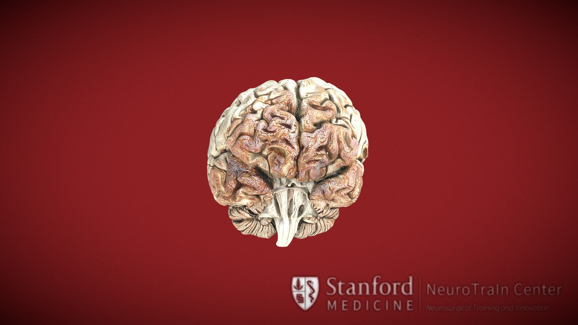 White Matter Dissection Of The Brainstem - 3D Model By Vv (@verav ...