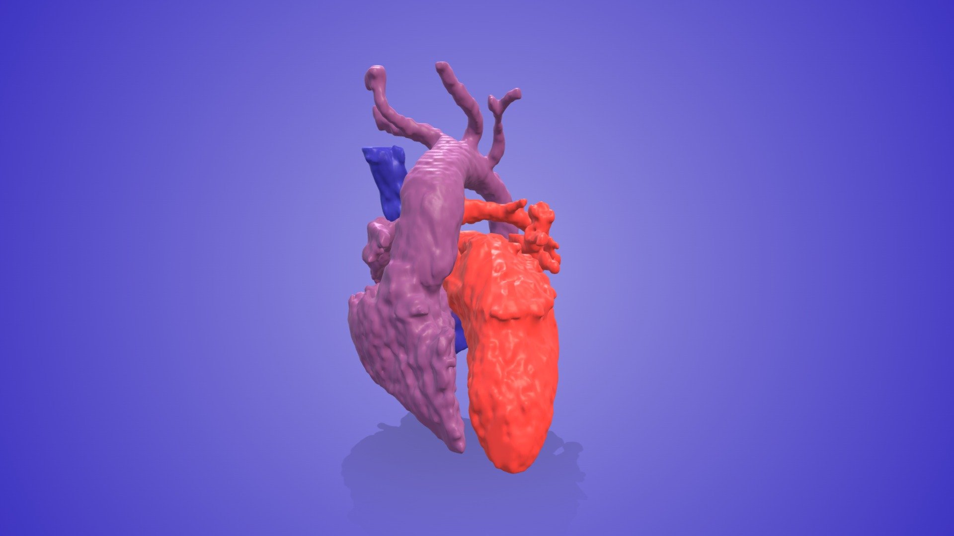 Transposition of the Great Arteries - Download Free 3D model by 3D ...