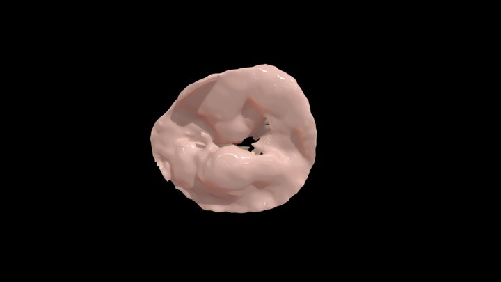 Mitral pre sugical analysis 3D Model
