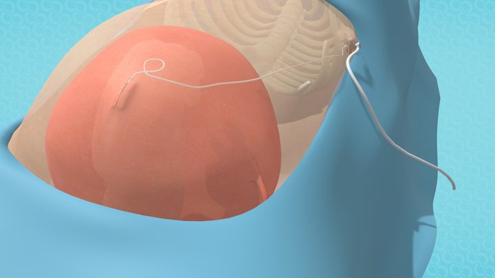 Amniotic Port_BOO 3D Model