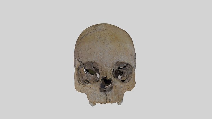 Skull of a 5-6-year old boy with four traumata 3D Model
