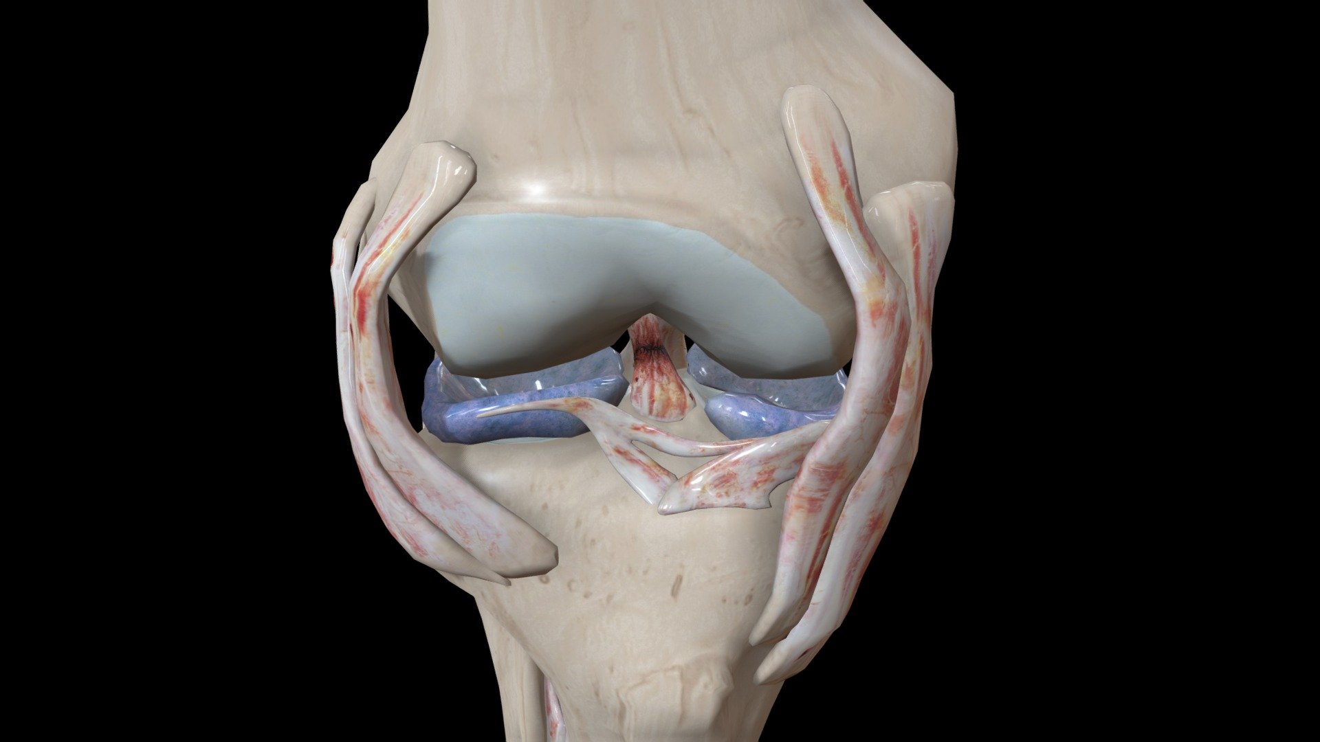 Torn Acl black line - 3D model by IU Indianapolis University Library ...