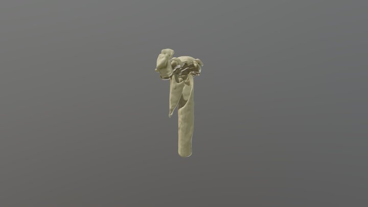 Humerusfraktur 2 3D Model
