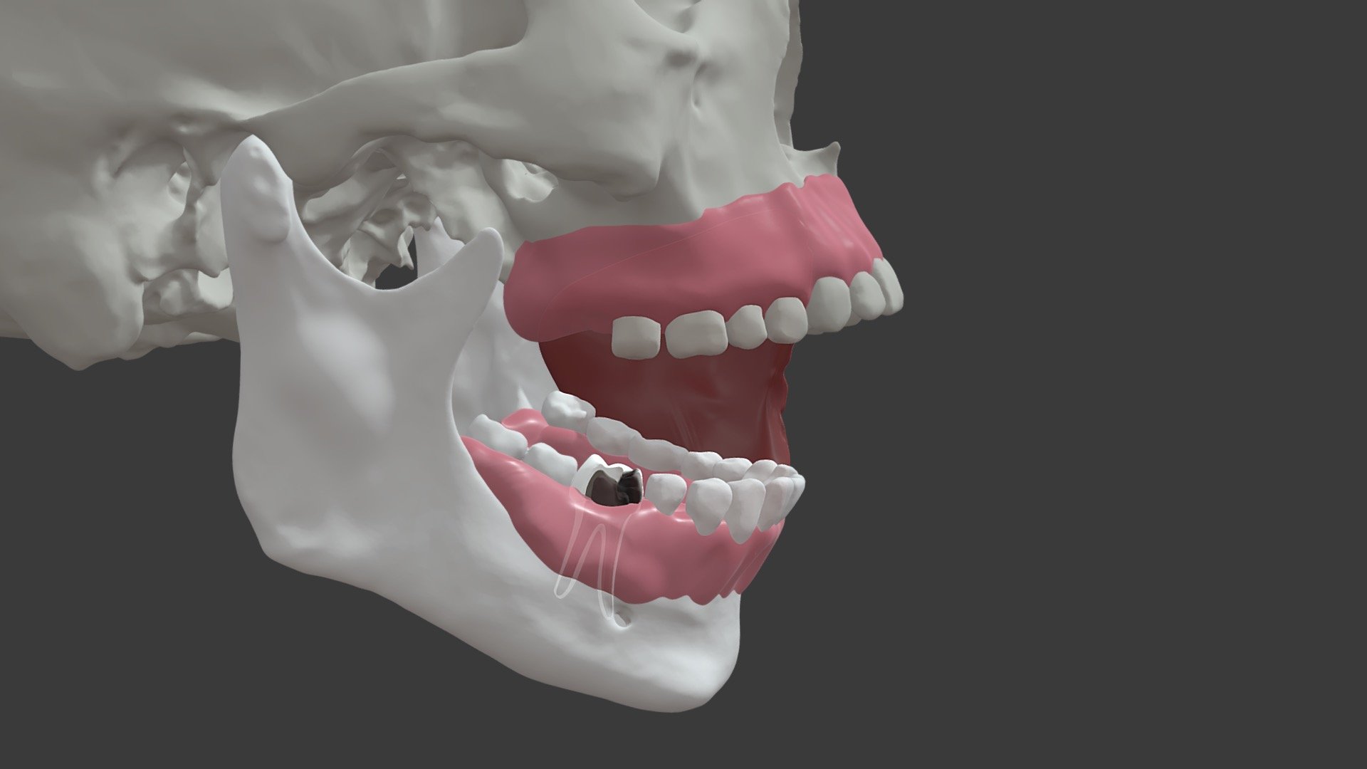 Stage 3 Mandibular Molar Infection Pathway 2 - 3D model by University ...