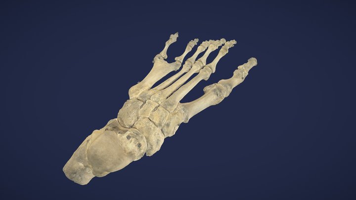 Polydaktylie Fuß links/ Polydactyly  left - copy 3D Model