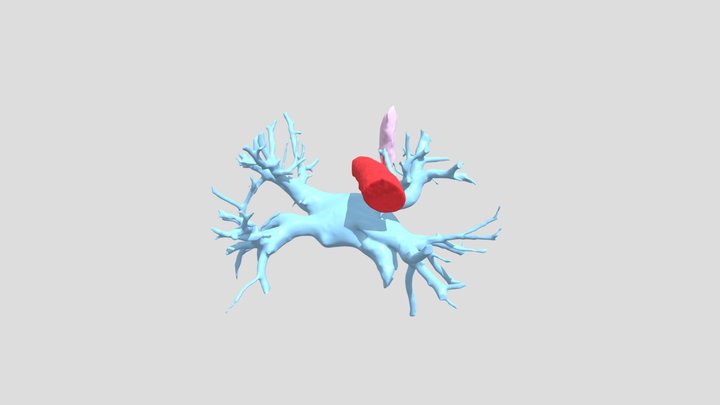 Intra-lobar Pulmonary Sequestration 3D Model