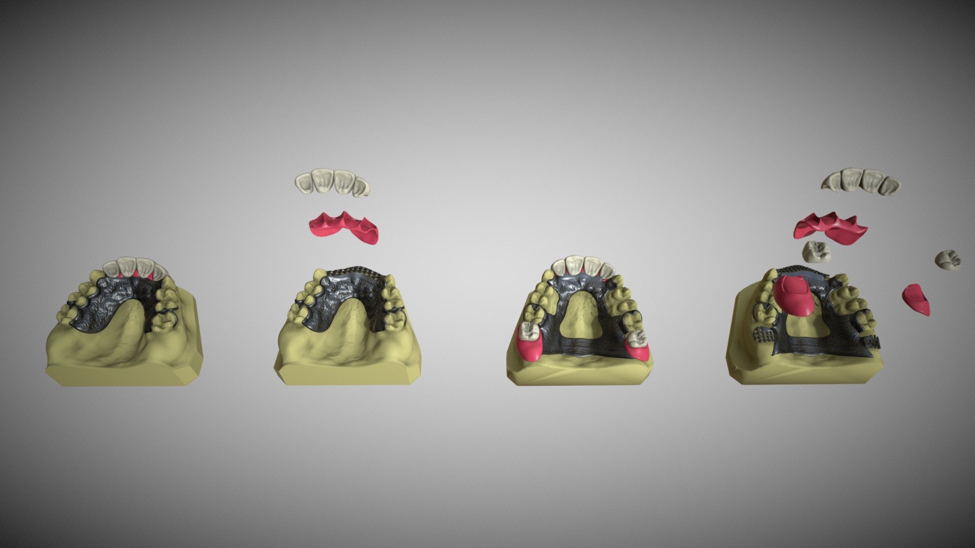 RPD Design for Class I and IV - 3D model by Muhammad Nabeel ...