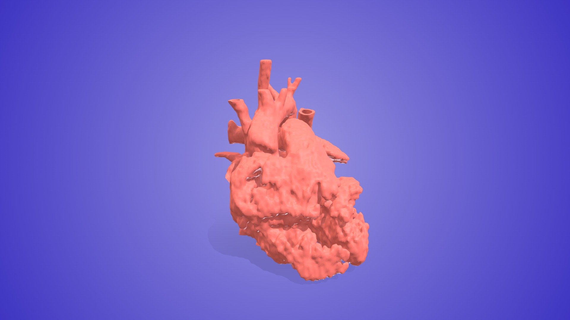 Aberrant Left Subclavian Artery