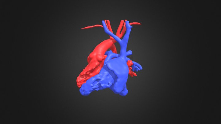 Situs inversus & transposition of the ventricles 3D Model