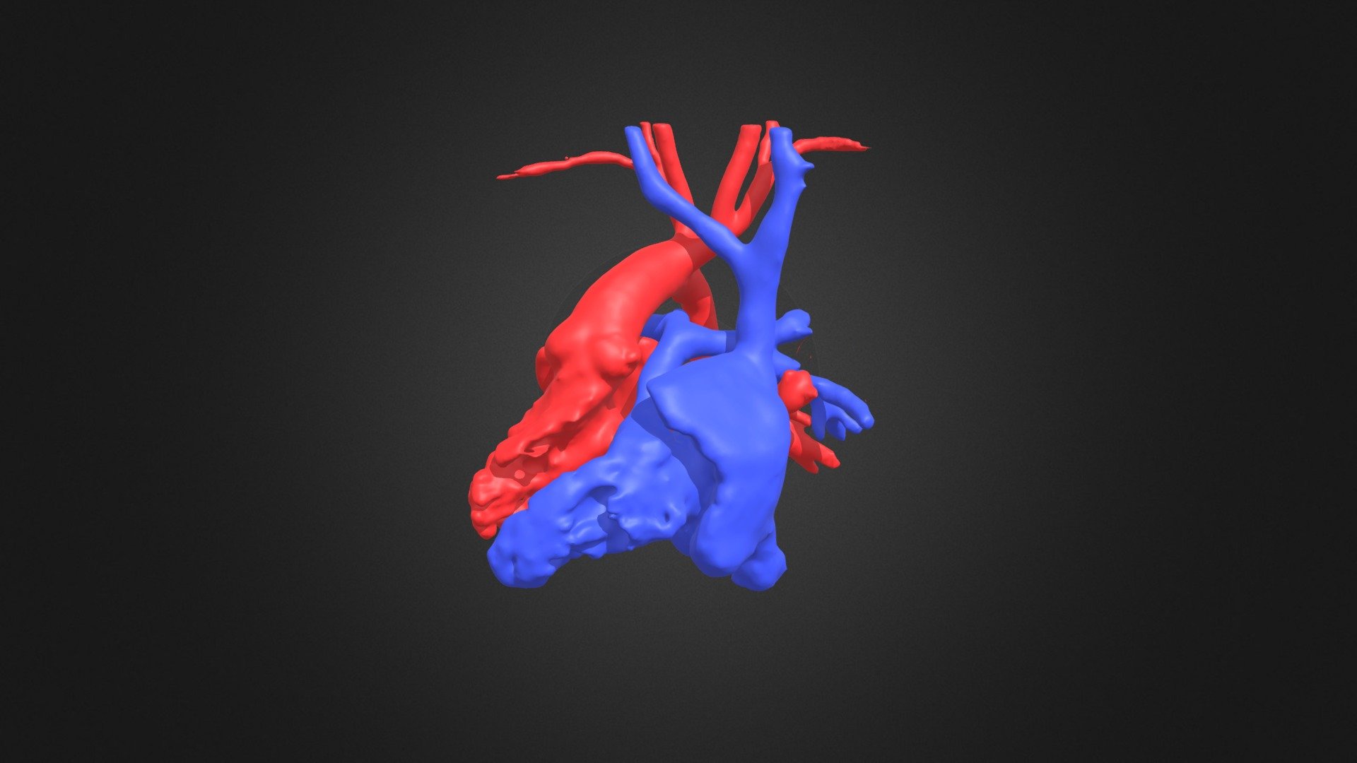 Situs inversus & transposition of the ventricles