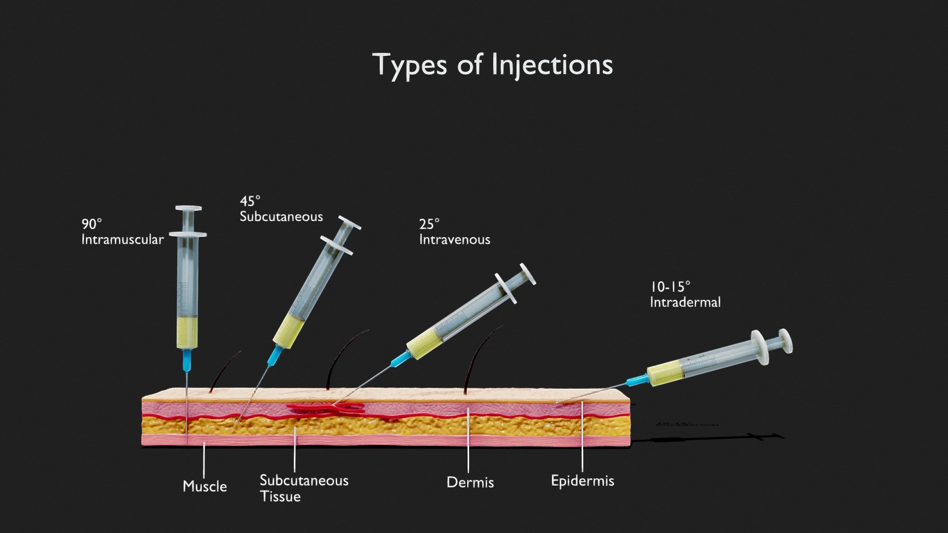 Types of Injections - With Animation - Buy Royalty Free 3D model by ...