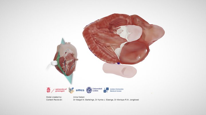 Tetralogy of Fallot, parasternal long axis – Modello 3D gratuito STL