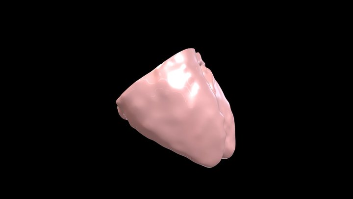 Case 33: AVV cut with patch 3D Model