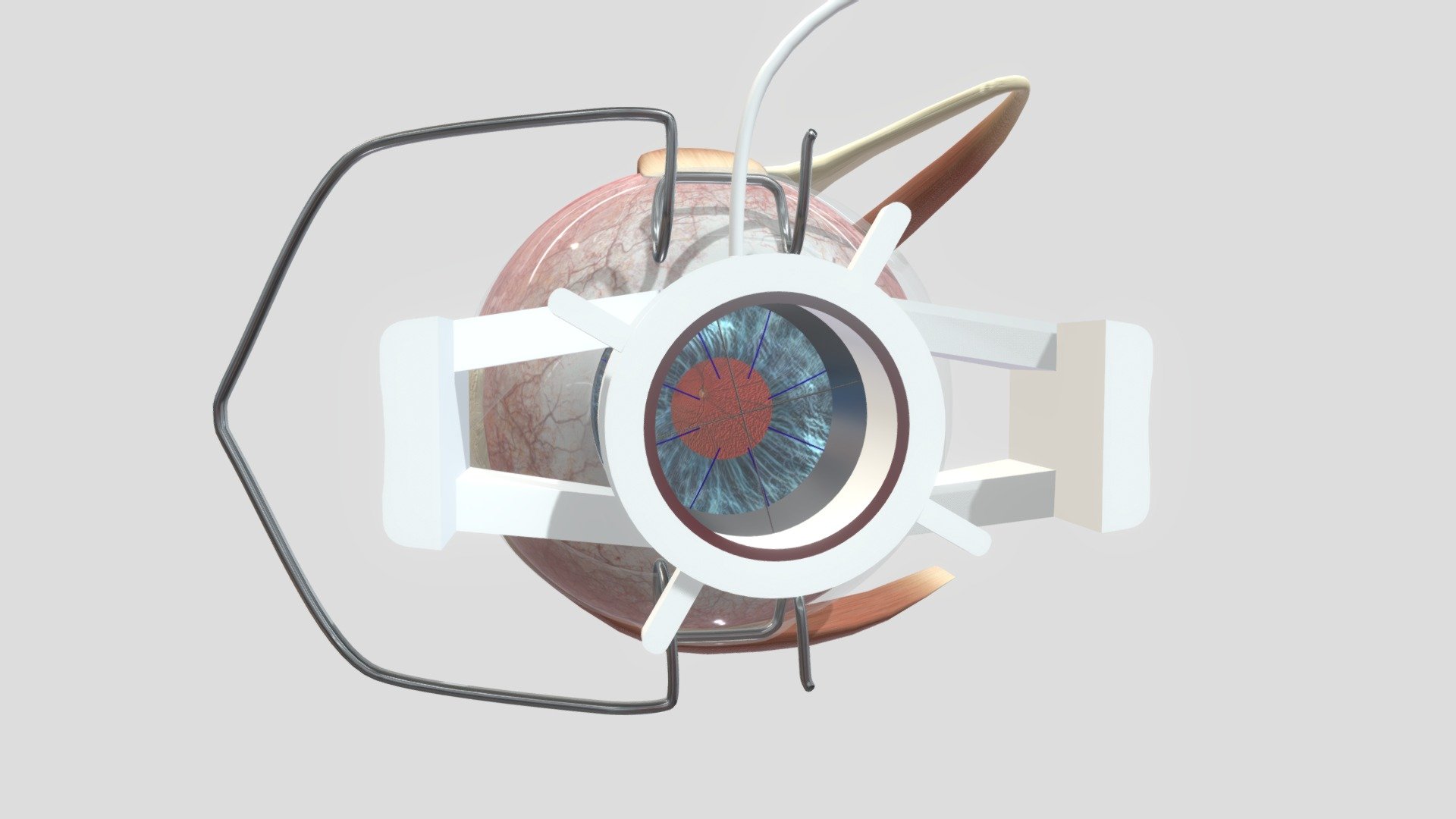 Penetrating Keratoplasty Step 2 3D Model By Holoxica f2cedc7 