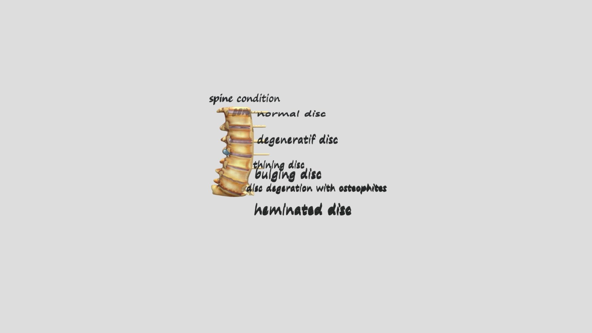 Spine Condition 1