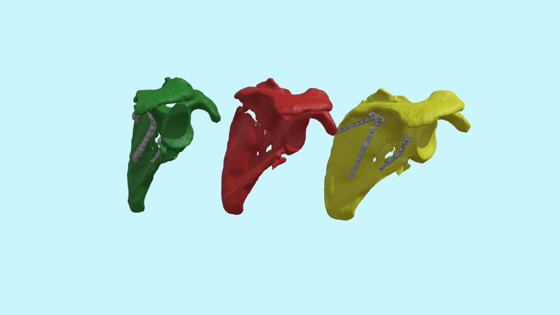 modelanatomic_wp1_postop