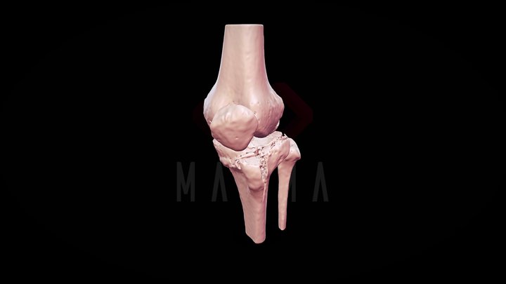 Knee Fracture 3D Model