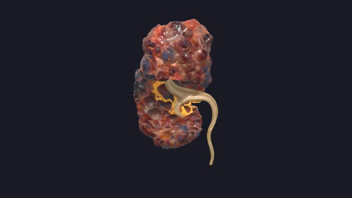 Polycystic Kidney 3D Model