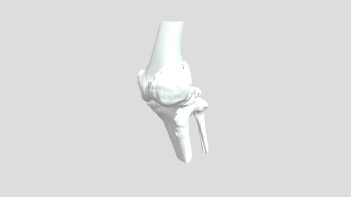 膝关节骨性关节炎 3D Model