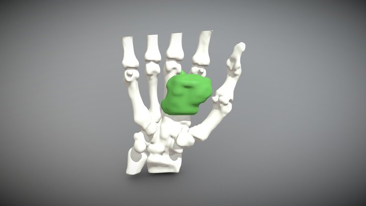TumorManoHueso 3D Model