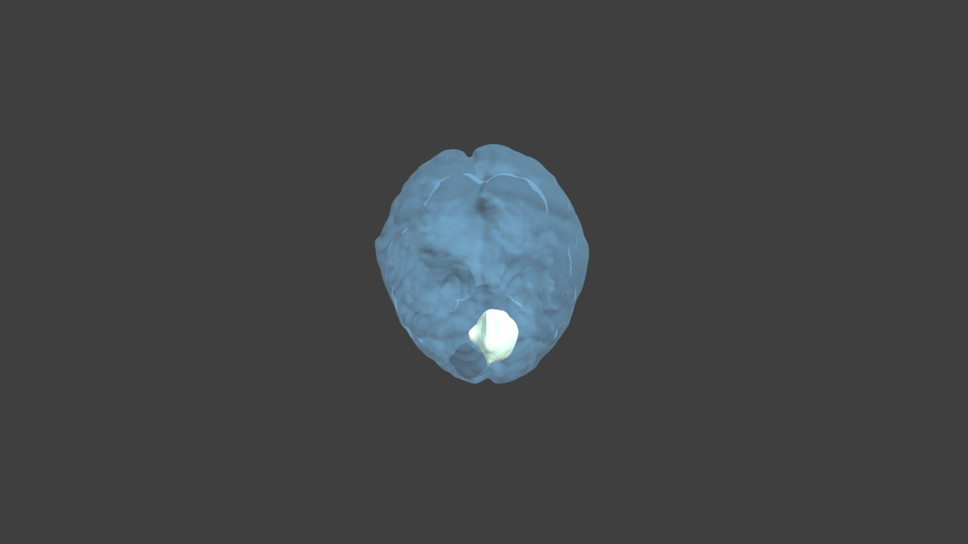 Tumors