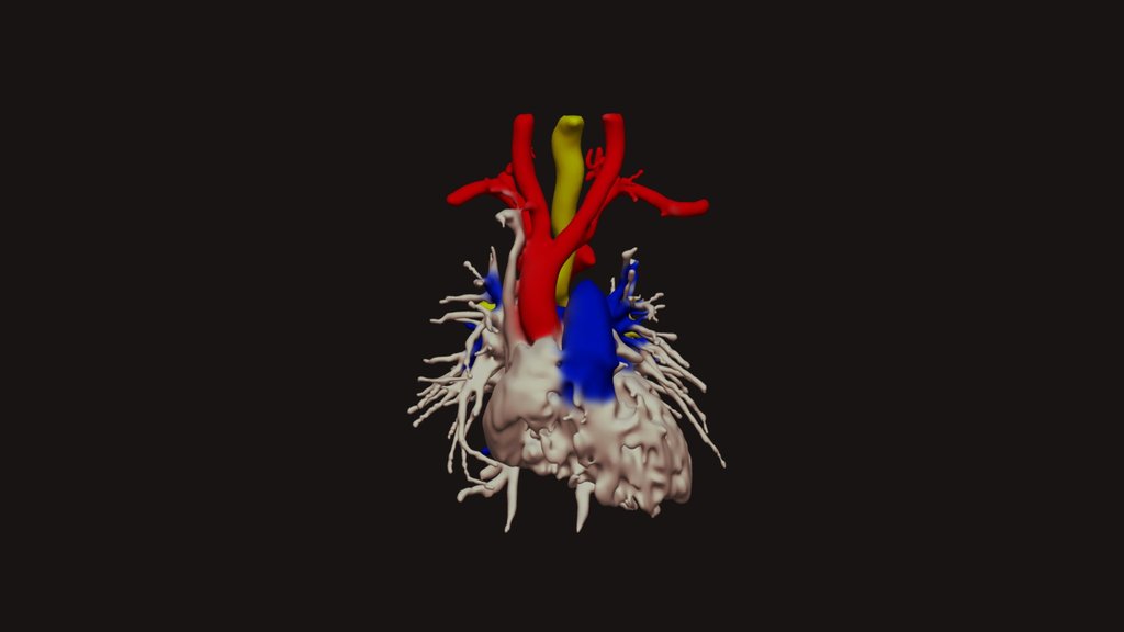 Mirror Right Arch with Diverticulum of Kommerell