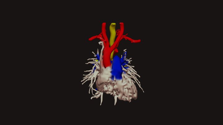 Mirror Right Arch with Diverticulum of Kommerell – Free 3D Model STL