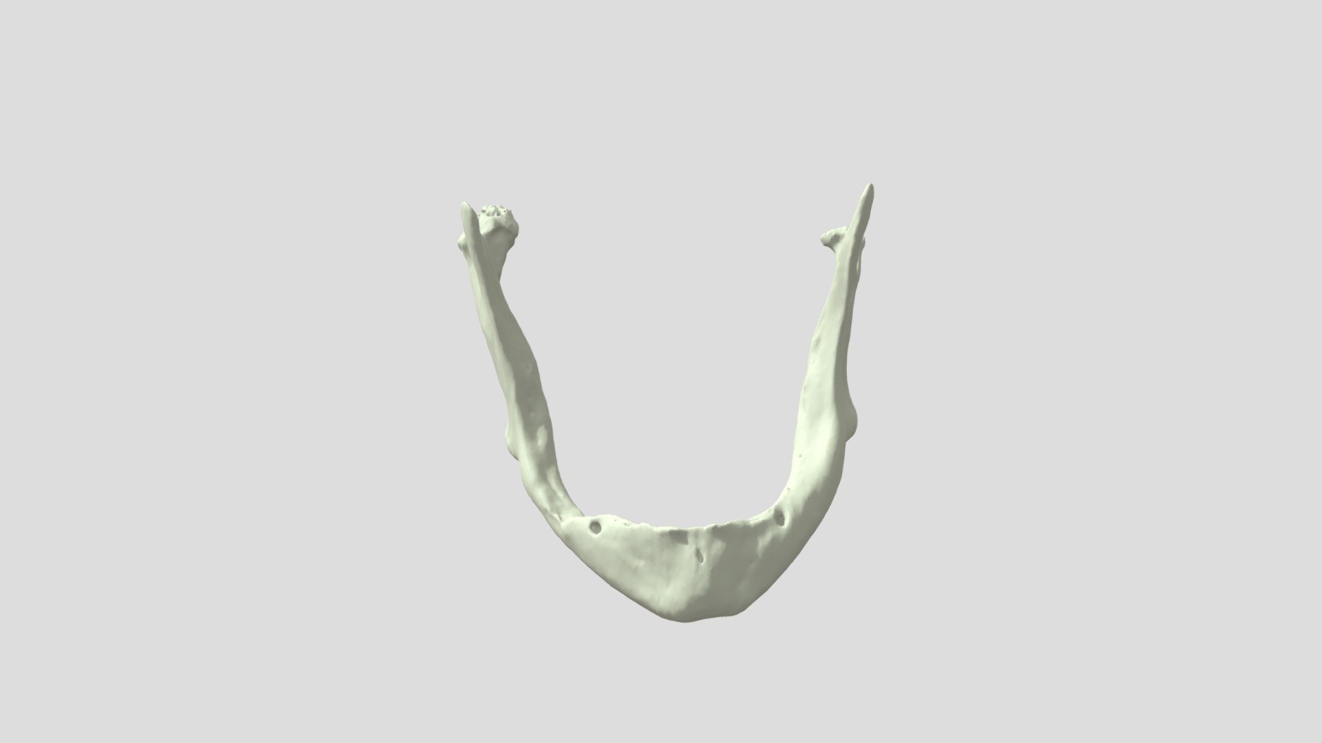 CMF02BA14062021 Mandibolare NEOPLASIA condilo DX