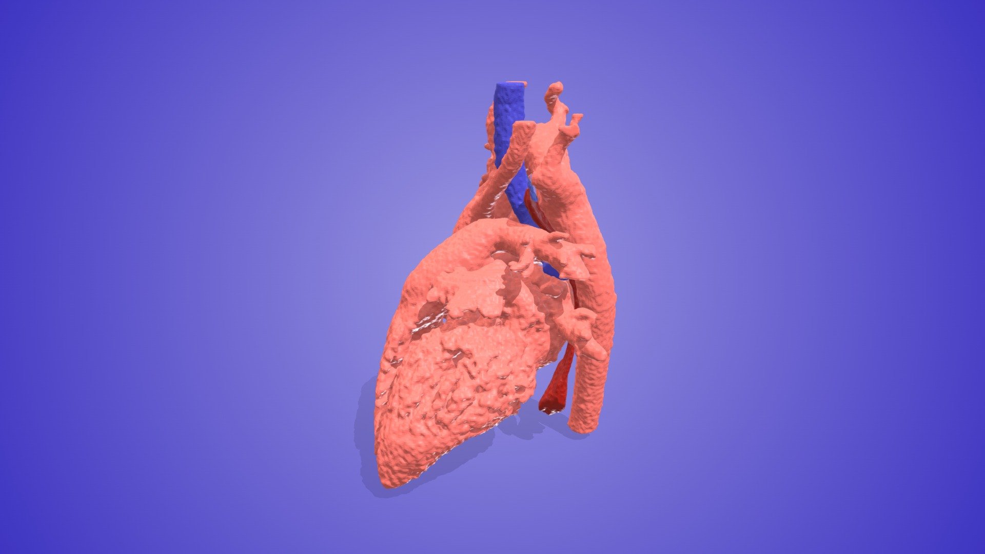Right Aortic Arch with Aberrant LSCA