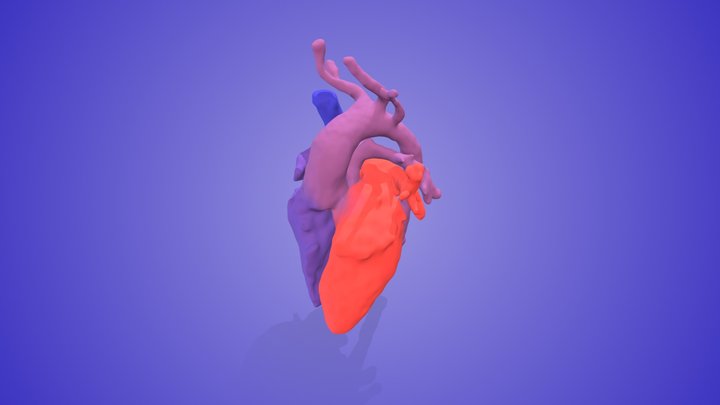 Transposition of the Great Arteries with VSD – Free 3D Model STL
