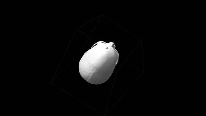 Left minipterional AcoA aneurysm 3D Model