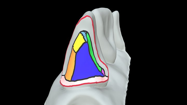 Areas on an Anterior Crown Preparation 3D Model