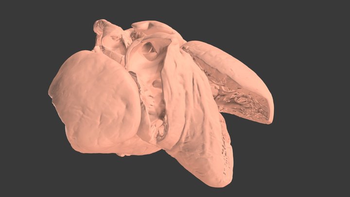 TA #4 - {S,D,S} w/ TA, canal VSD, ASD 1&2, PLSVC 3D Model