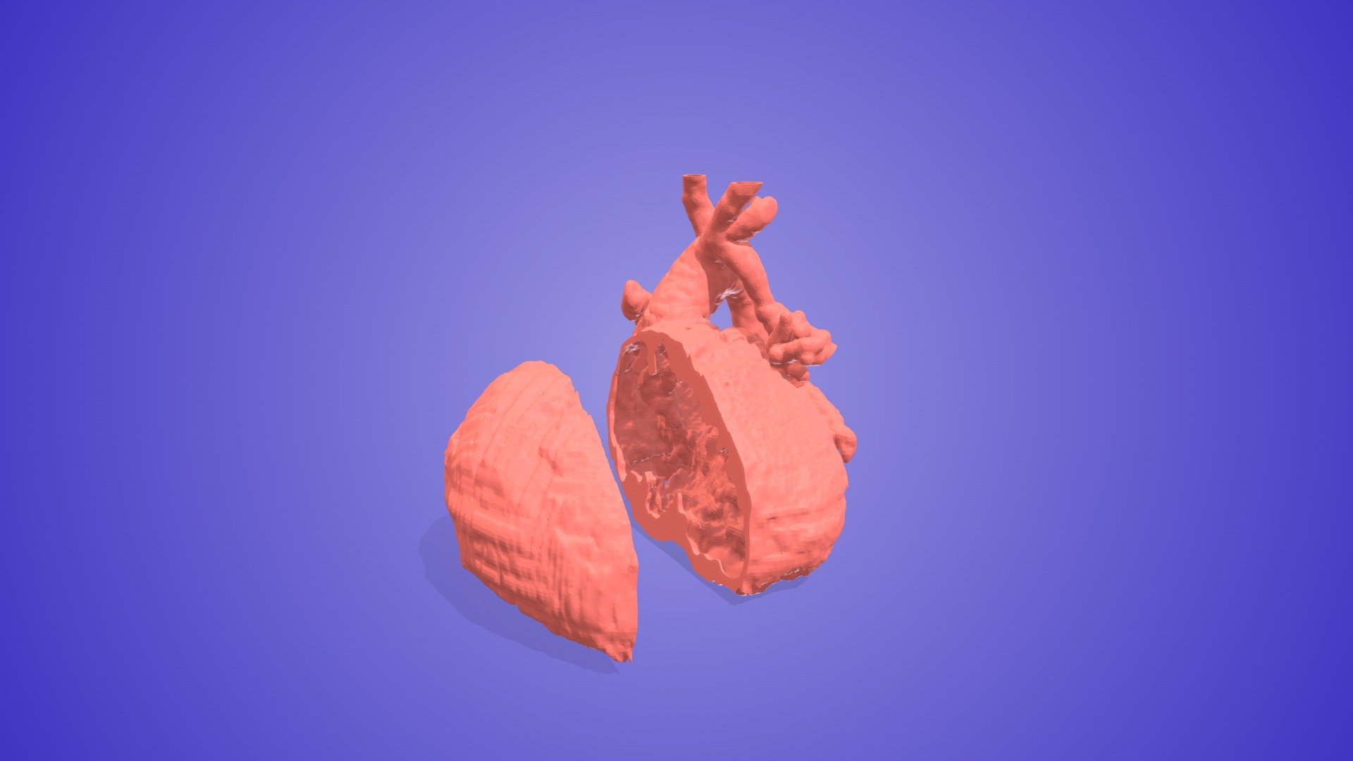 Tetralogy of Fallot