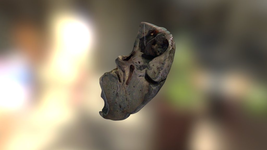 Aspergilloma, lung