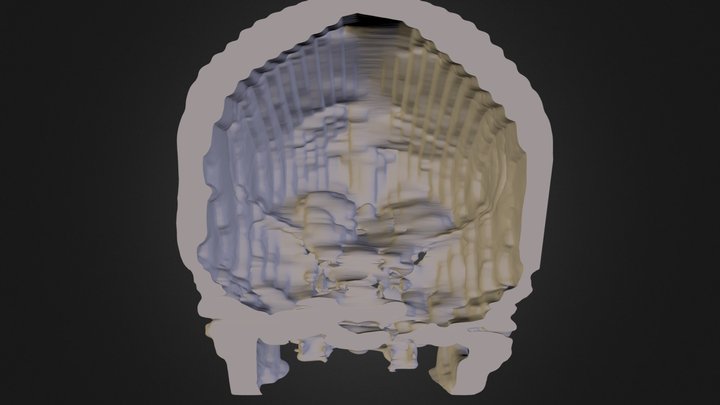Anterior skull section with skull based tumor – Free 3D Model STL