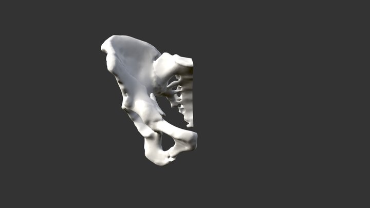Pelvis Fracture - Both Column 3D Model