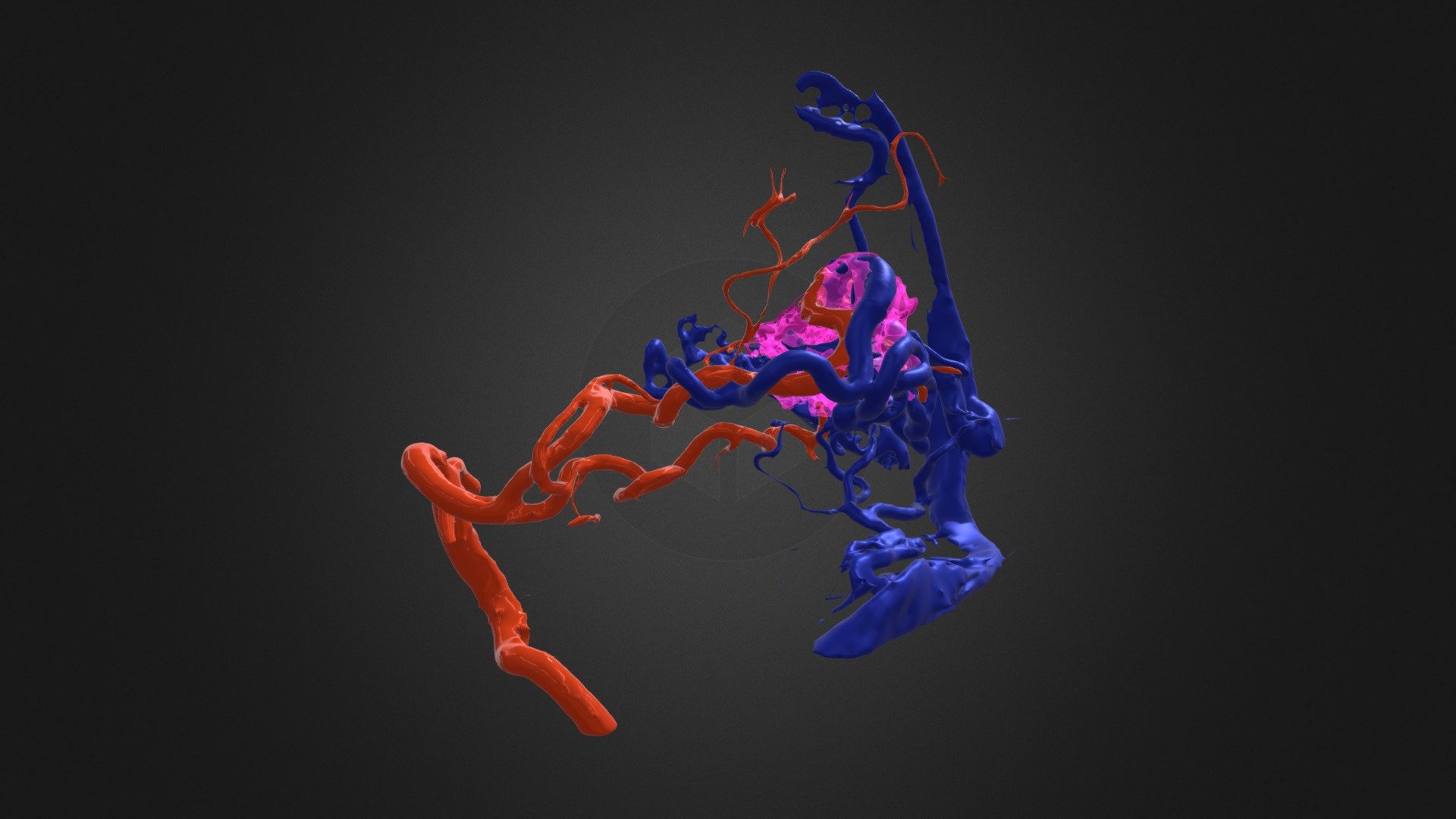 Occipital AVM
