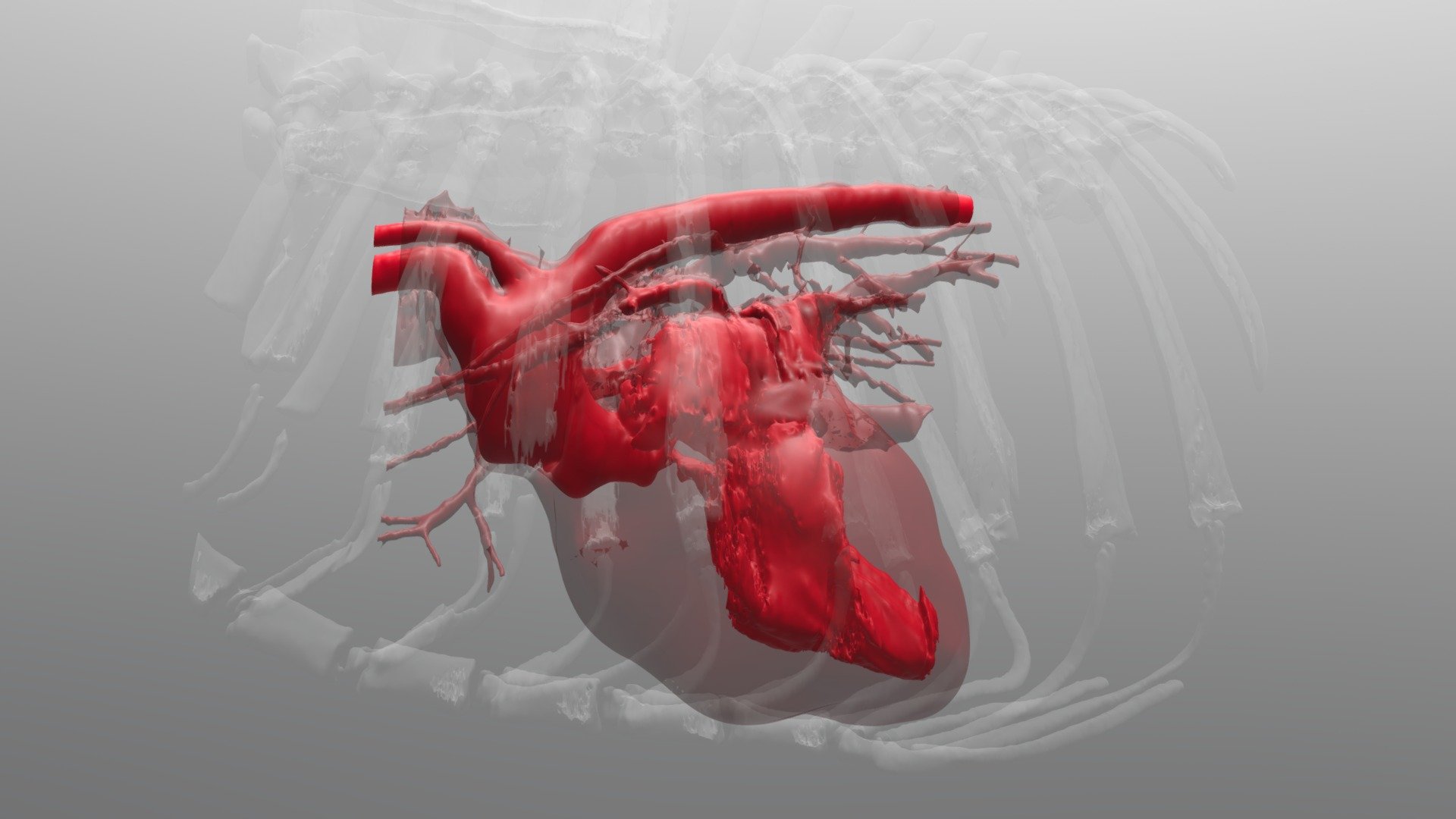Canine Subaortic Stenosis (SAS) - 3D model by Pixelbeaker [f7aa906 ...