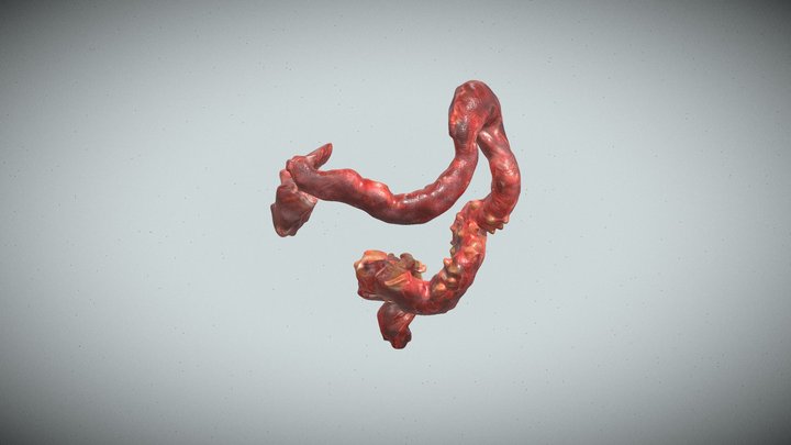 Diverticulosis Diverticulitis Colon Perforation 3D Model
